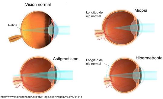 defectos de refraccion